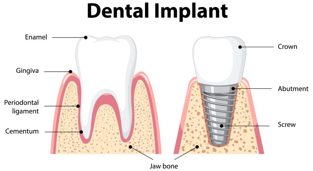 implanturile dentare